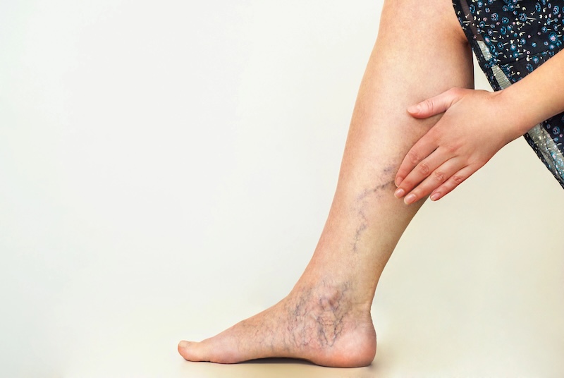 varicose veins